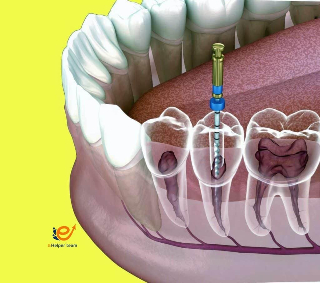 Root Canal Treatment in Wilmington 5 Root Canal Treatment in Wilmington